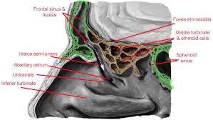 Maxillary Sinus Sinusitis Maxillary Sinus Paranasal Sinuses