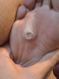 But not everybody that comes into contact with the virus develops warts. All About Trying To Get Rid Of My Huge Disgusting Verruca Tales From The River