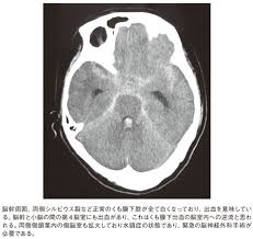 Jun 30, 2021 · くも膜下出血によって、アルツハイマー型認知症になりましたなんてまず有り得ない。仮に認知症だとしても、この女性の行動から見て、アルツハイマー型なんて診断されないだろう。 他の人も言っているが、高次脳機能障害と見るべきだろう。 è¦‹é€ƒã—ã¦ã¯ãªã‚‰ãªã„ã‚¯ãƒ¢è†œä¸‹å‡ºè¡€ æ—¥çµŒãƒ¡ãƒ‡ã‚£ã‚«ãƒ«