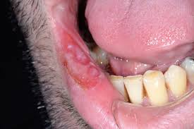 Syphilis is a highly infectious sexually transmitted infection (sti) caused by bacteria, which is usually spread through vaginal, anal, or oral sex. Oral Syphilis A Case Report Scottish Dental Magazine