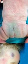 Image result for Skin Trauma