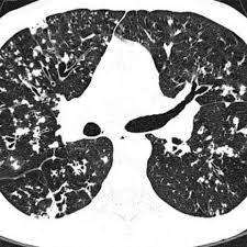Cf pri­ marily affects the respiratory and digestive systems in children and. Dangerous Bacteria Infecting Cystic Fibrosis Patients Around The Globe