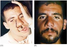 Maybe you would like to learn more about one of these? Maxillofacial Reconstruction Of Ballistic Injuries Intechopen