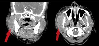 Image result for phlegmon on face)