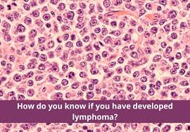 Different types of hodgkin lymphoma can grow and spread differently and may be treated differently. Lympoma Symptoms Causes Treatment And