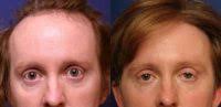 The procedure begins with a tiny incision being made over the adam's apple. Doctor Toby Mayer Md Facial Plastic Surgeon Eyelid Surgery Cost Photos Rewiews Q A