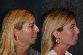 One of my favorite things about facial plastic surgery is the opportunity  to combine multiple small procedures to achieve a dramatic result. This  patient wanted to rejuvenate her appearance and underwent  #uppereyelidsurgery #