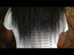 Basic and specific (basp) classification for pattern hair loss (from: Anemia Iron Deficiency Excessive Shedding My Devastating Hair Loss Part 1 Youtube