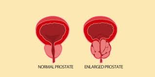Kanker prostat merupakan bentuk kanker ganas yang tumbuh pada kelenjar prostat. Begini 6 Cara Efektif Untuk Mendeteksi Kanker Prostat Merdeka Com