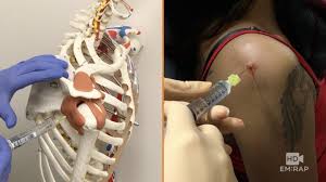 Image result for Shoulder Injection