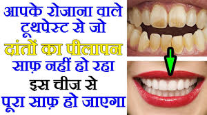 Wisdom teeth are a third set of molars in the back of your mouth. White Teeth Health Tips In Hindi à¤ª à¤² à¤¦ à¤¤ à¤¸à¤« à¤¦ à¤•à¤°à¤¨ à¤• à¤˜à¤° à¤² à¤¨ à¤¸ à¤– White Teeth By Sachin Goyal Youtube