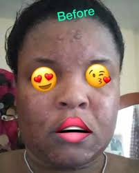 Men Koman Kliyan te ye , rekonesans se yon gwo zam!!! Li dim ke li te  gentan depanse plis ke 2000 us nan tretman pou figil e anyen pat janm  mache, ak