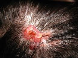 Any of the three main types of cancer that can occur on your skin can appear on the scalp: Nevus Of Jadassohn Springerlink