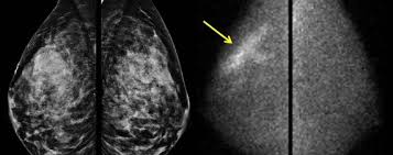 In this mammogram image, the breast calcifications are in ductal patterns. New Screening Tests For Hard To Spot Breast Cancers Wsj