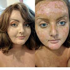 I Had Really Bad Sunburn Tried To Get A Spray Tan Made It Worse How I Used Makeup To Look Less Like A Diseased Carrot Makeupselfies