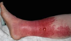 Image result for erysipel photos)