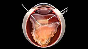 Our physicians are board certified by the american board of ophthalmology. Retinal Detachment Warning Signs Treatment