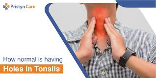 Make sure you eat properly so that you won't accidentally damage tonsils. Doctor S Advice On How Normal Is Having Holes In Tonsils