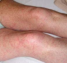 Straining while coughing, vomiting, lifting something heavy, exercising vigorously, or using the bathroom damage from uv. Petechial Rash On The Thighs In An Immunosuppressed Patient Mdedge Dermatology