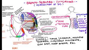 Brown Sequard Syndrome Central Cord Syndrome Incomplete Spinal Cord Injury Youtube