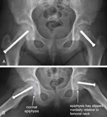 Image result for Hip XRay