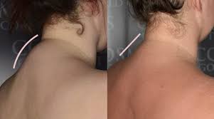 A rounded mass or protuberance, such as 2. What Is Buffalo Hump And Can I Remove It