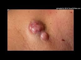Image result for Dermatofibrosarcoma Protuberans