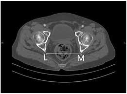 Check spelling or type a new query. Ct Pelvimetry And Clinicopathological Parameters In Evaluation Of The Technical Difficulties In Performing Open Rectal Surgery For Mid Low Rectal Cancer