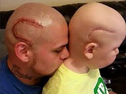 Tattooing over scars is more difficult than a normal tattoo. Dad Gets Tattoo To Match His Son S Surgery Scar Abc News