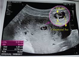 slow fetus growth small gestational sac end of my pregnancy