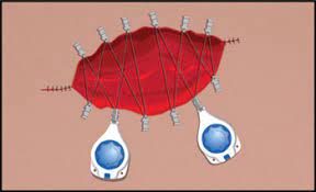 Dermaclose A Great Alternative To A Skin Graft