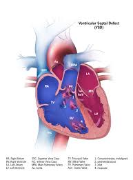 Ventricular Septal Defect Wikipedia