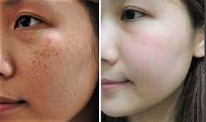 化粧 おしゃれまとめの人気アイデア pinterest maria そばかす レーザー 顔のシミ 美容