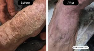 Image result for Lichen Simplex Chronicus