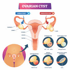 (the american college of obstetricians and gynecologists says how often you need them depends on what you and your doctor agree upon based on your medical history and any. Fibroids Vs Cysts What S The Difference Responsum For Fibroids
