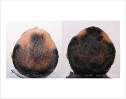 Dermaroller For Hair Loss Before And After Result In Male Patient Hair Loss Before And After Hair Loss Men Prp Hair Therapy Before And After
