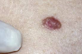 But this common form of cancer can also occur on areas of your skin not ordinarily exposed to sunlight. Skin Cancer And Rashes Cancerous And Precancerous Lesions