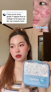 Revita Glow: Trust the Process for Pimple-Free Skin