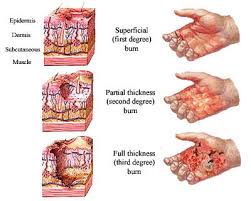Burns It S Management Nursing Path