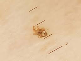 Fleas and mites do bite. Bird Mite Infestation Dermnet Nz