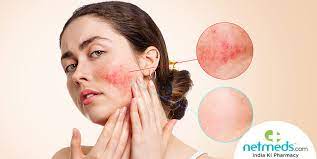 Wash every day with a gentle. Rosacea Diy Face Masks To Naturally Reduce Skin Redness And Flare Ups
