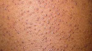 Image result for Keratosis pilaris