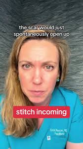 #stitch with @Dr. Erin Nance 🇺🇸 #eds #heds #connectivetissuedisorder  #hypermobility #comorbidity #mcas #pots #cci #tetheredcord #chiari  #gastroparesis #endometriosis