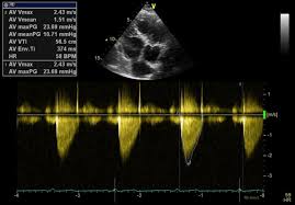 Dyspnoe echokardiographie befund vorlage , bron:link.springer.com pulsoximetrie stand und entwicklung der technik biomedizinische echokardiographie befund vorlage, echo befund vorlage. Herzerkrankungen Dr Barbara Zweytick