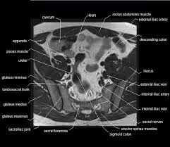Maybe you would like to learn more about one of these? Mri Pelvis Anatomy Free Male Pelvis Axial Anatomy