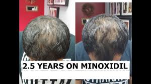 However, our only concern is the price tag. 2 5 Years On Minoxidil Does Minoxidil Work For Balding Or Hair Loss Youtube