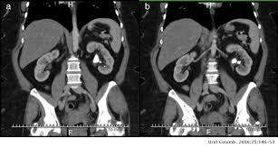 If a staghorn stone is not treated, then renal. Retrograde Flexible Nephrolithotomy In The Management Of Large Lithiasic Masses As An Alternative To Percutaneous Nephrolithotomy Urologia Colombiana