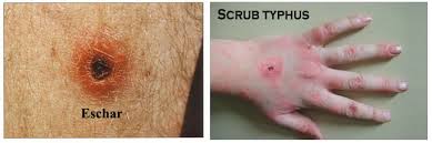 Image result for Typhus