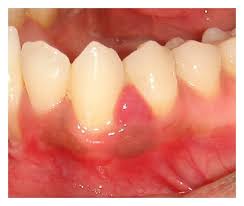 Image result for granuloma gum disease