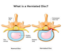Maybe you would like to learn more about one of these? Slip Disc Meaning